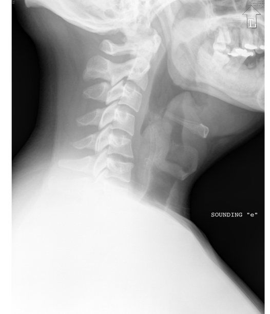 EMR051814fig%202%20lateral%20radiograph%20epiglottitis.jpg