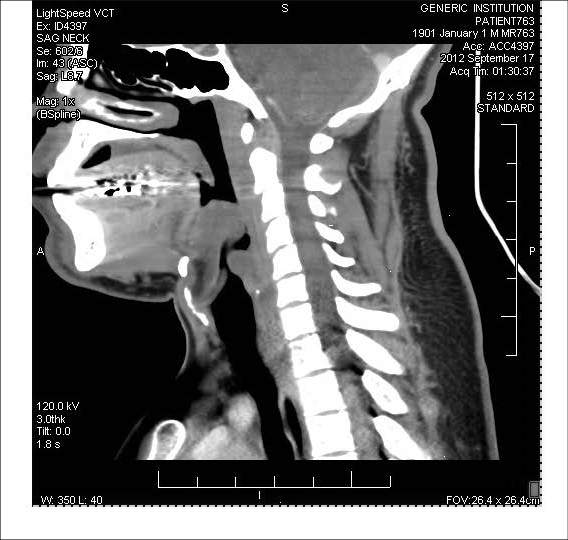 EMR051814fig4%20swelling%20epiglottis.jpg