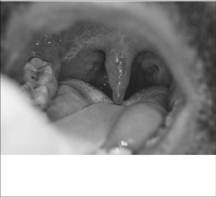 uvula-disease-fig-1.jpg