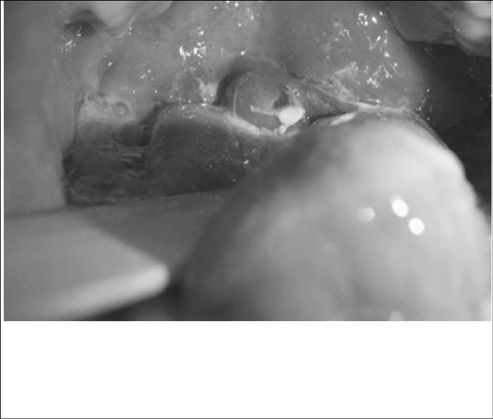 uvula-disease-fig-3.jpg