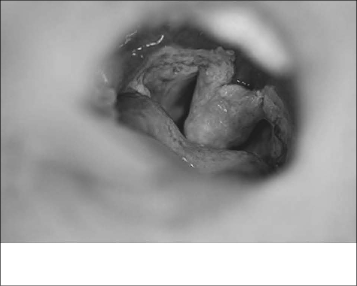 uvula-disease-fig-5.jpg