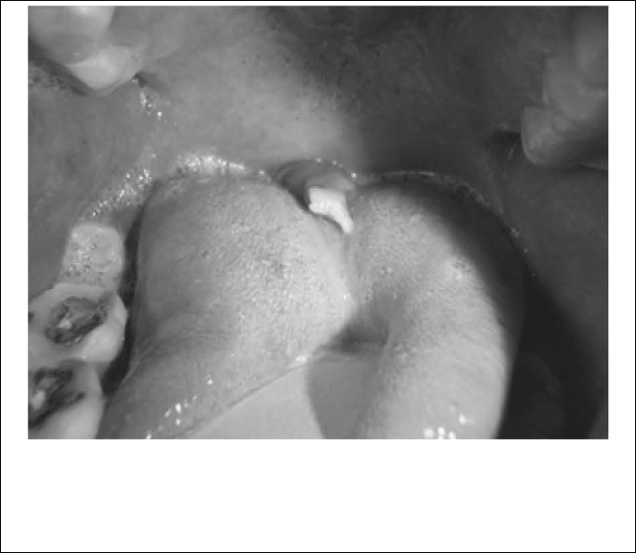 uvula-disease-fig-6.jpg