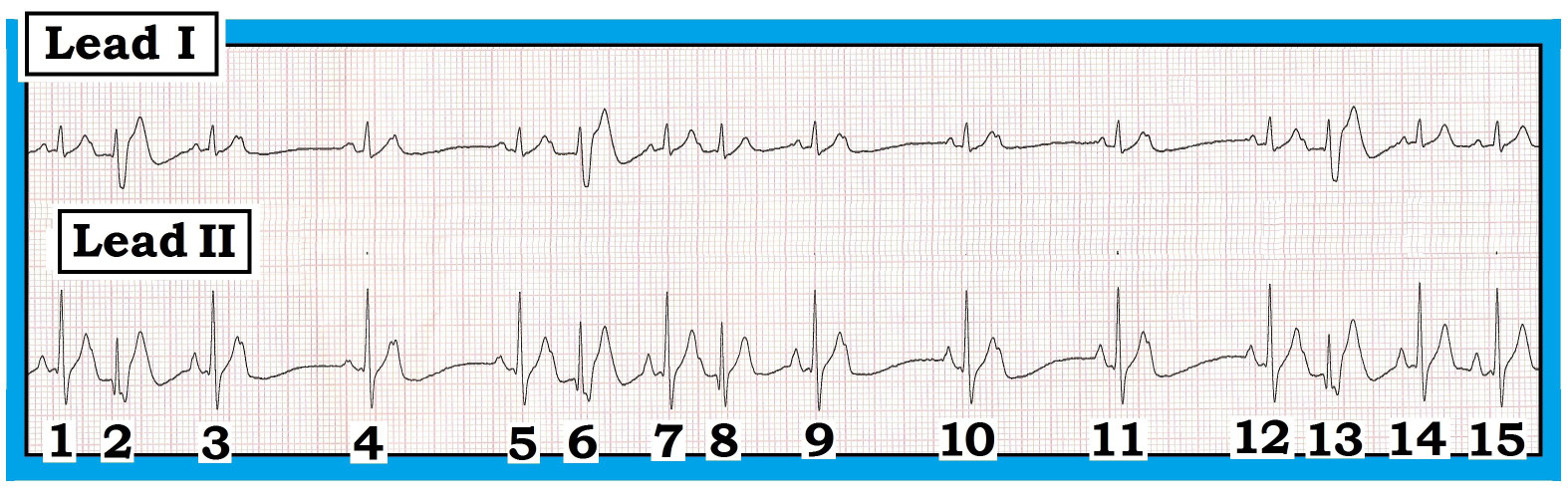 ECGFIGURE.jpg