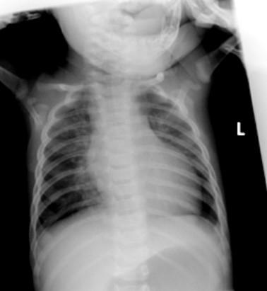 CXRCARDIOMYOPATHY.bmp