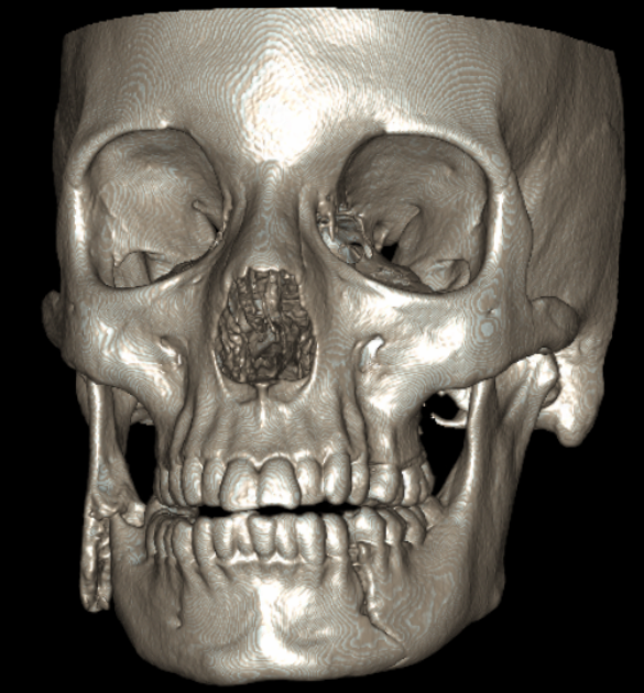 mandible1.png
