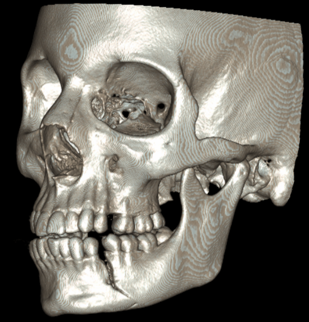 mandible2.png