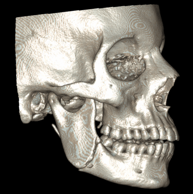 mandible3.png