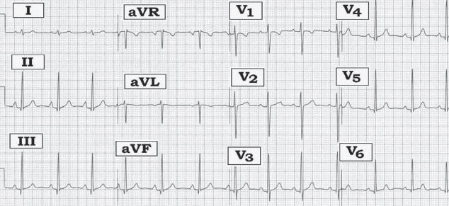 ecg