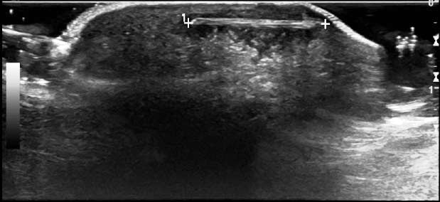 foreignbodyfootopt.jpg