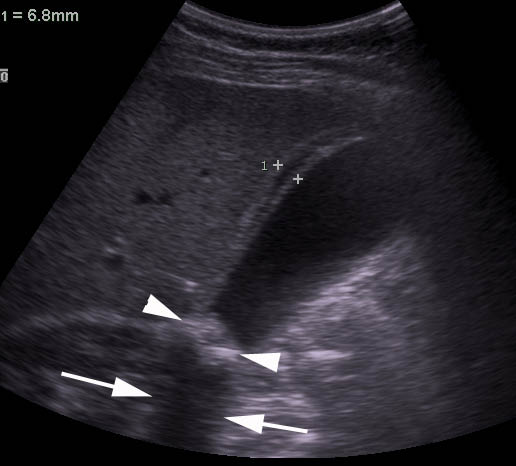 Figure_3_US_Cholecystitis.jpg