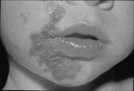 PDMR1211impetigo.tif