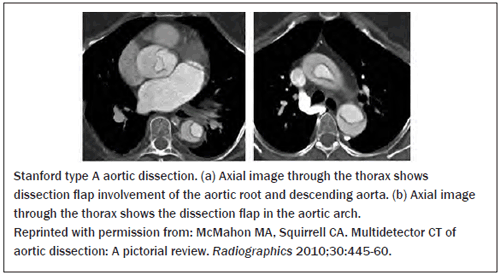 Stanford Type A Aortic Dissection