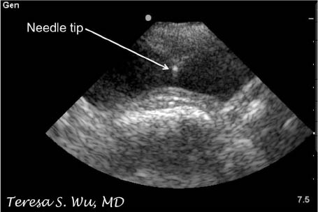 EMR021411fig16suprapubic aspiration with needle tip in bladder_0001.jpg