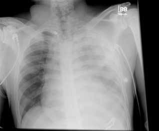 Figure 1 - Hemothorax after GSW.jpg