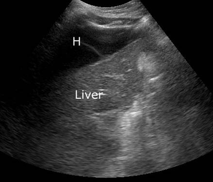Figure_6a_US_perihep_hematoma.jpg