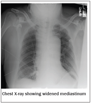 Chest X-ray
