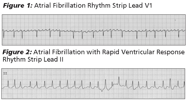 Afib in WPW rate 131 cropped.jpg