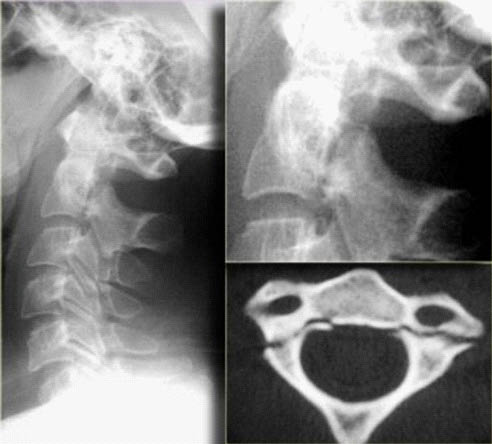 EMR061812 fig 10 hangman's fracture.pdf