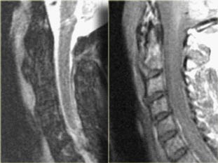EMR061812 fig 12c extension teardrop MRI.pdf