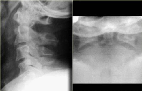 EMR061812 fig 9 type II odontoid fracture.pdf