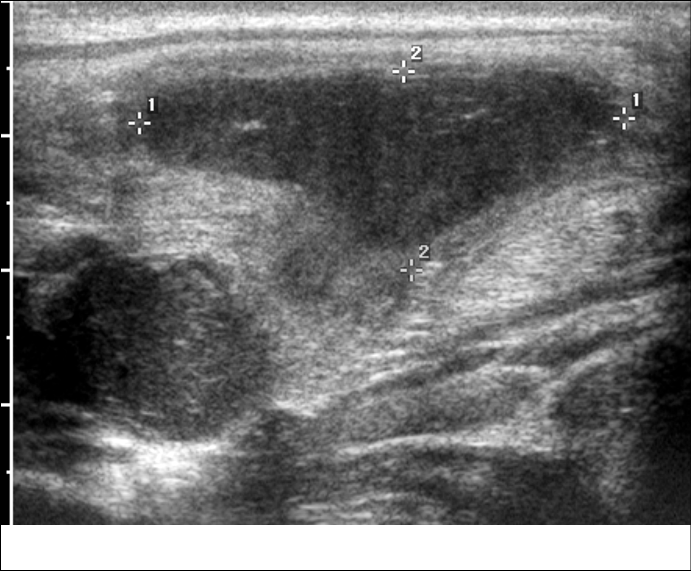 US%20of%20infected%20branch%20cyst.tif