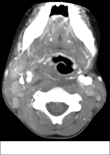 retropharyngeal%20abscess%20CT.tif