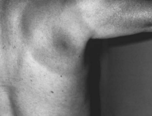 Fig%204%20erythema%20migrans.jpg