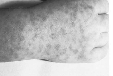 Figure%2010%20purpura%20rash.jpg