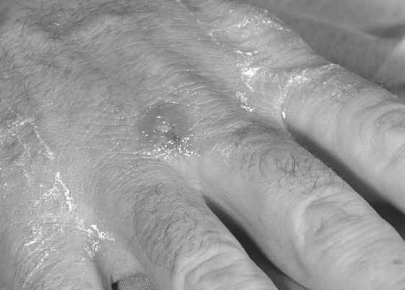 Figure%2011%20ulcerative%20lesion%20tularemia.jpg
