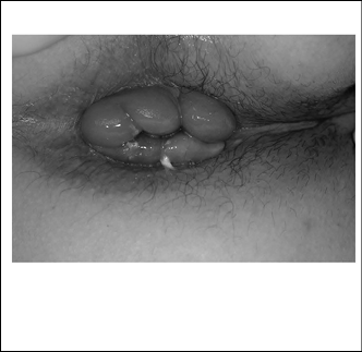 EMR050414fig1external%20hemorrhoid.jpg