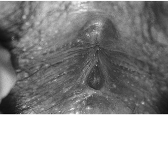 EMR050414fig2anal%20fissure.jpg