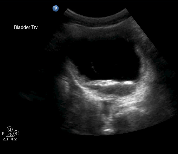 Bladder%20debris%20trv.bmp