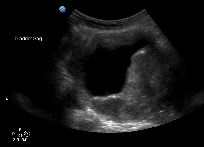 bladder%20debris%20sag.bmp