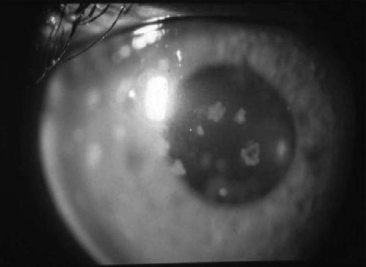 Anterior uveitis_0001.jpg