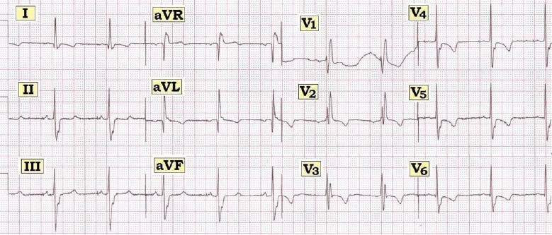 ECG #236.JPG