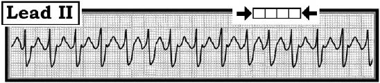 ECG Review 243-Figure 1 (grey).jpeg