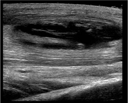 EMR021411fig18 abscess_0001.jpg