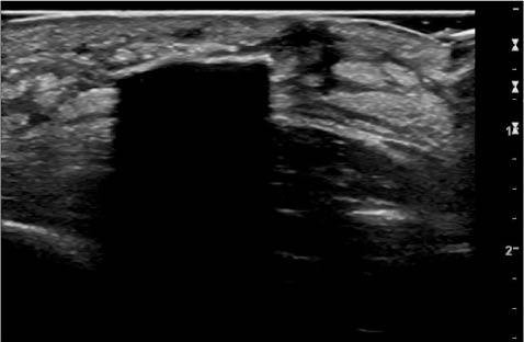 EMR021411fig20 foreign body with acoustic shadowing_0001.jpg