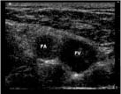 EMR021411fig8 femoral vein and artery_0001.jpg