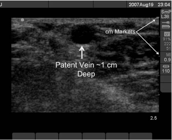 EMR021411oval shaped vein fig1_0001.jpg