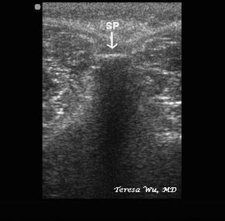 EMR022811fig10 spinous process in transverse view_0001.jpg