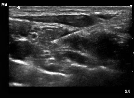 EMR022811fig14 US guided nerve block_0001.jpg