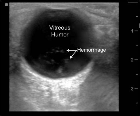 EMR022811fig17 vitreous hemorrhage_0001.jpg