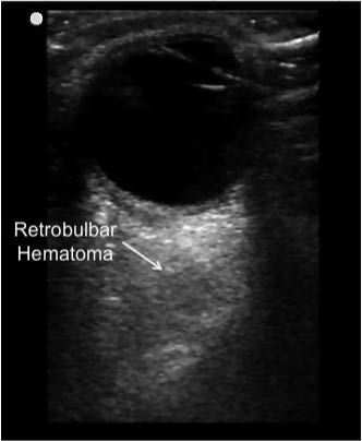 EMR022811fig19 retrobulbar hematoma_0001.jpg