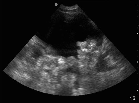 EMR022811fig8 ascites and loops of bowel_0001.jpg