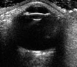 EMR022811fig 15 US eye normal view_0001.jpg