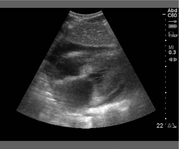 EMR022811fig 1 pericardial effusion new_0001.jpg