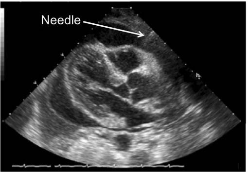 EMR022811fig 2 needle entering pericardium subxiphoid_0001.jpg