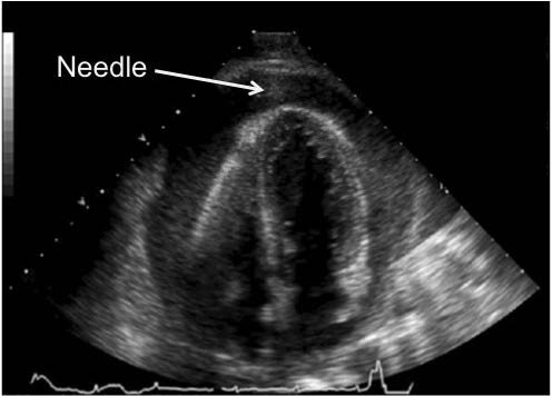 EMR022811fig 3 needle entering pericardium apical_0001.jpg