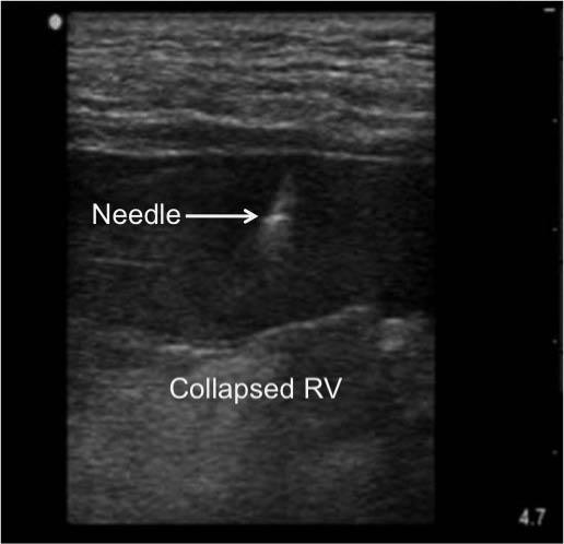 EMR022811fig 4 apical approach to pericardiocentesis_0001.jpg